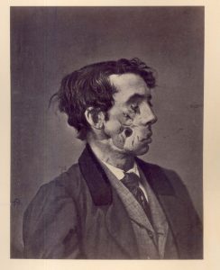 "Shell Wound of the face, with great destruction of the soft parts." Private Joseph Harvey, Co. C, 149th New York Volunteers. Wounded at Chancellorsville, Virginia on May 3 1863. The text on the back of the photo reads: Private Joseph Harvey, C, 149th New York, was wounded at the battle of Chancellorsville, May 3, 1863, by a fragment of shell. The right eye was destroyed, the right superior maxilla was fractured, a fragment was chipped off the lower jaw, and the right cheek was frightfully lacerated. The prisoner fell into the hands of the enemy, and remained a prisoner eleven days. In the middle of June, 1863, he was admitted into Mansion House Hospital, at Alexandria. In August, portions of exfoliated bone were removed. A ferrotype, representing the apperance of the wound at this date, was forwarded to the Army Medical Museum. On May 7, 1865, Harvey was discharged from service on account of physical disability. He was subsequently employed as a night-watchman at the Commissary Hospital in Alexandria. The photograph was taken June 22, 1865. The loss of substance in the cheek was still unrepaired, and liquids and saliva escaped frrom it. There was slight deafness and partial facial paralysis on the right side. This soldier was pensioned, and his death, from cause not known, was reported December 9, 1868 -- George A. Otis.