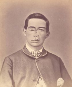 Shell wound of the face. Pvt. William H. Nims, Co. D, 61st New York Volunteers, wounded 17 June 1864, at the Battle of Petersburg, Va.